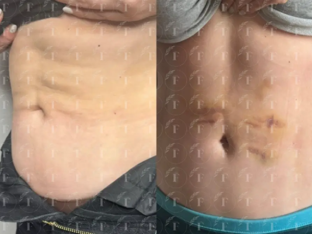 Endolift Felavi Center