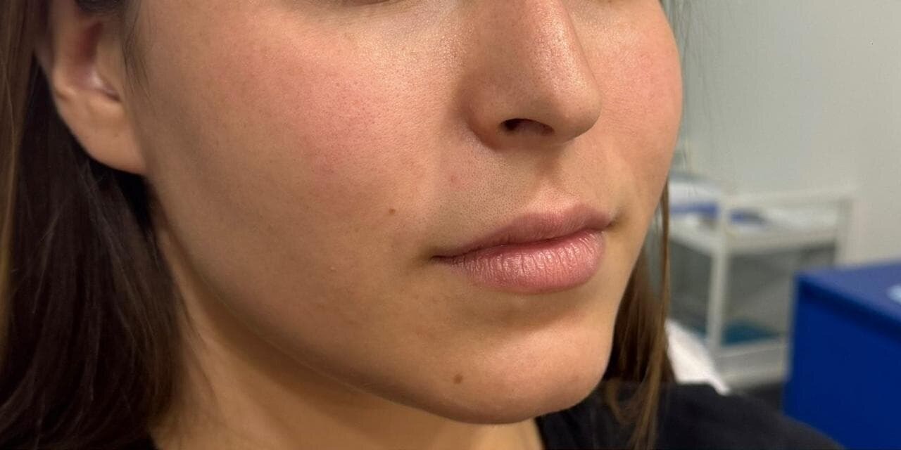 ANTES · Aumento de labios