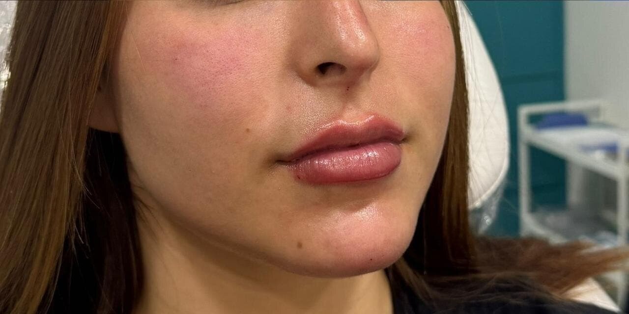 DESPUÉS · Aumento de labios