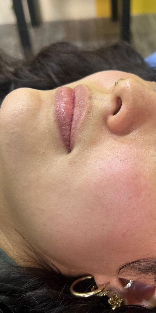 ANTES · Aumento de labios