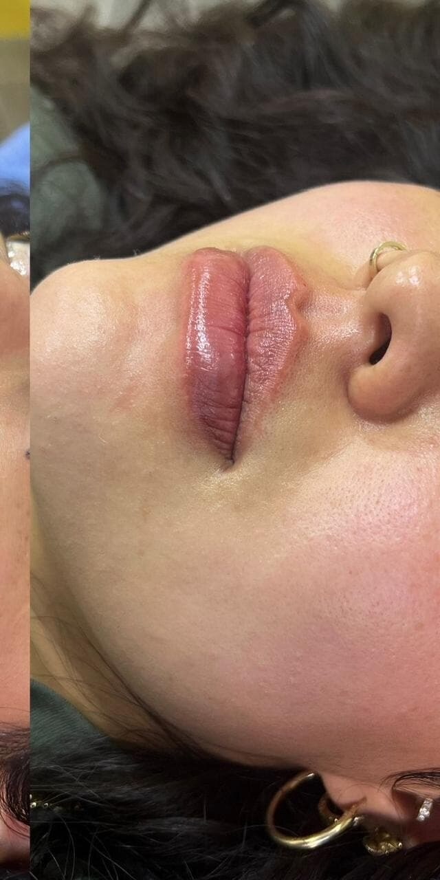 DESPUÉS · Aumento de labios