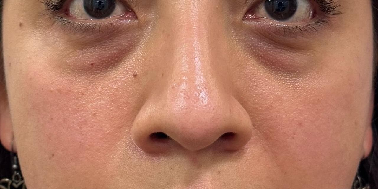 ANTES · Relleno de ojeras