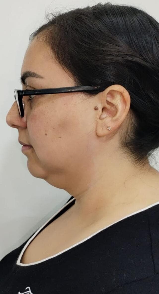 ANTES · Lipo de papada