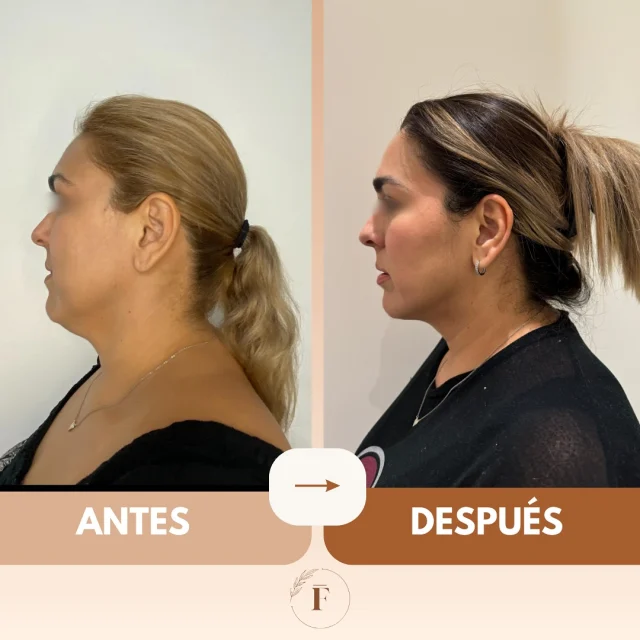Tirzepatide: ¡La Revolución para Bajar de Peso que Estabas Esperando! –  Felavi Center